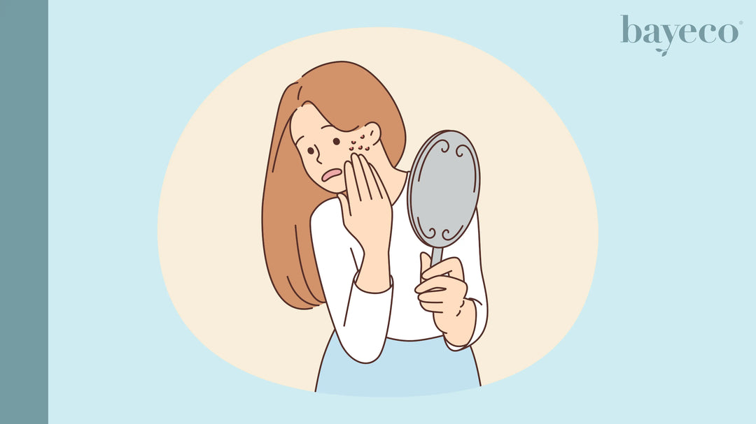 Stress Breakouts? Here’s How to Calm Your Skin Naturally